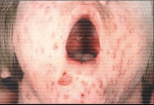 [IMAGE: chicken pox]