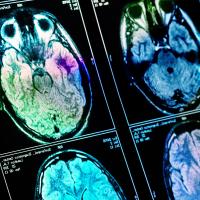 multicoloured CT scans of brains